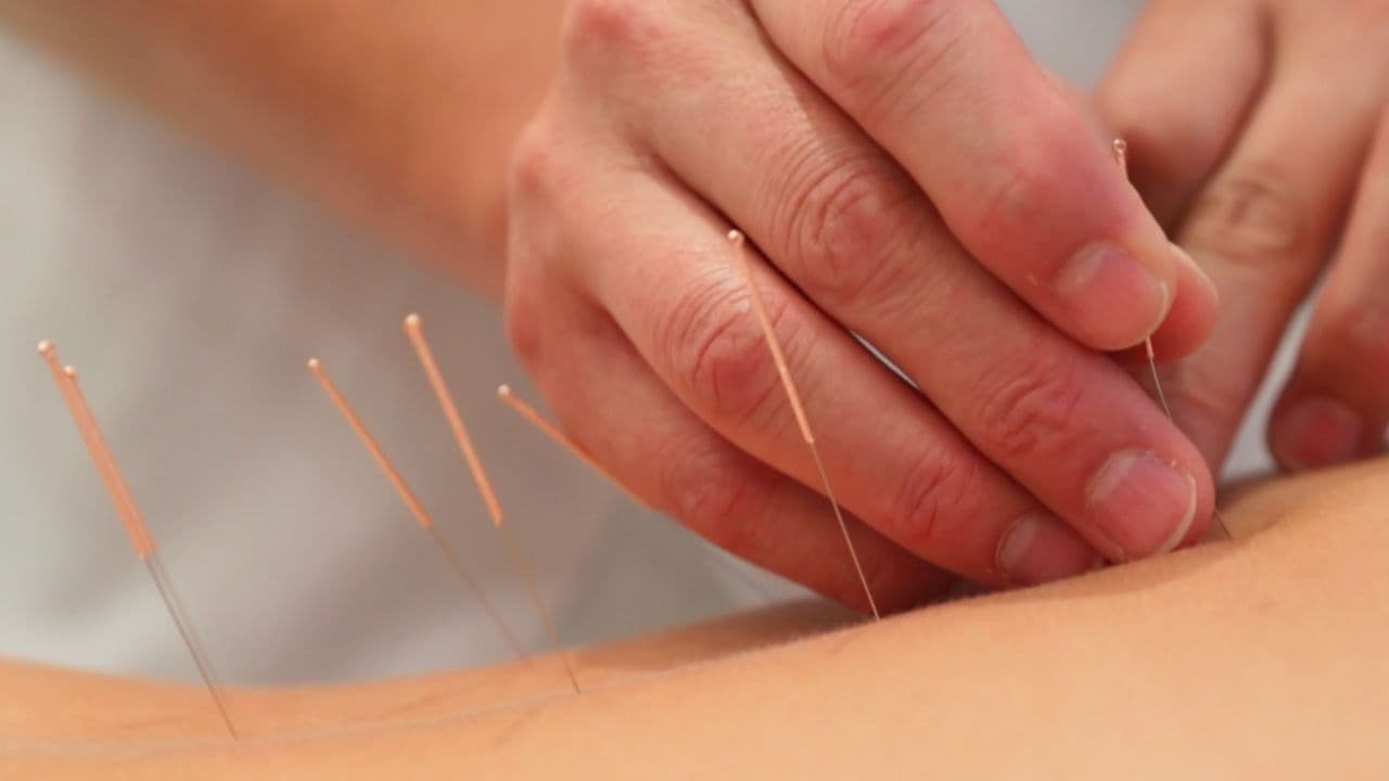 Acupuntura en ASR Fisioterapeutas